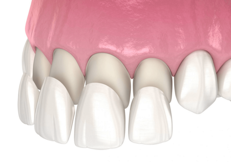 Digital rendering of veneers being placed on top of teeth.