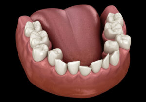 Digital rendering of a mouth with crowded teeth.